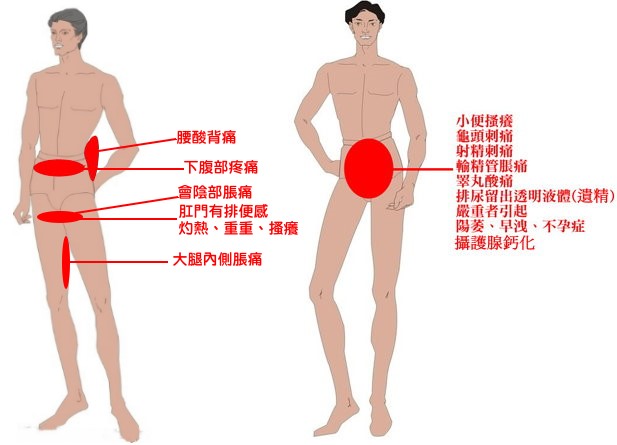 前列腺炎症状有哪些？〖四大预警信号要注意〗