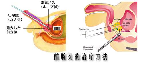 前列腺炎如何治疗&急慢性前列腺炎的护理方法