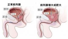 前列腺肥大怎么治疗？【5个保养前列腺秘诀要知道】