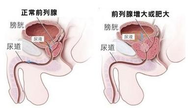 前列腺肥大怎么治疗?【5个保养前列腺秘诀要知道】