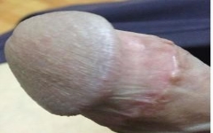 为什么龟头皮皱皱的?要怎么滋润?