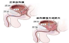 前列腺增大能恢复吗?怎样预防增大加重?