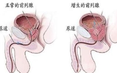 多过性生活前列腺肥大多缓解吗?三种行为易“犯事”